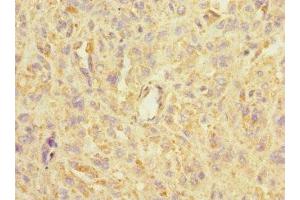 Immunohistochemistry of paraffin-embedded human melanoma using ABIN7143004 at dilution of 1:100 (ASIC3 抗体  (AA 62-320))