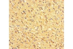 Immunohistochemistry of paraffin-embedded human glioma using ABIN7154018 at dilution of 1:100 (GATD3A (AA 43-268) 抗体)