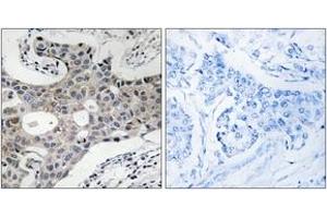 Immunohistochemistry analysis of paraffin-embedded human breast carcinoma, using SEC16A Antibody. (SEC16A 抗体  (AA 1013-1062))