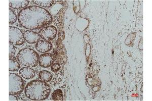 Immunohistochemistry (IHC) analysis of paraffin-embedded Human Colon Carcicnoma using GRP78/Bip Mouse Monoclonal Antibody diluted at 1:200. (GRP78 抗体)