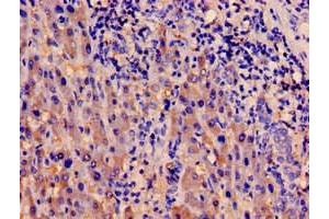 Immunohistochemistry of paraffin-embedded human liver cancer using ABIN7142002 at dilution of 1:100 (PDPK1 抗体  (AA 294-432))