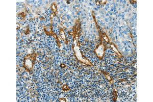 Immunohistochemistry of Human cervical cancer using CAV1 Polyclonal Antibody at dilution of 1:40 (Caveolin-1 抗体)