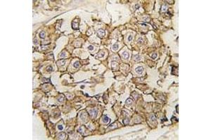 IHC analysis of FFPE human breast carcinoma tissue stained with ErbB2 antibody (ErbB2/Her2 抗体  (AA 21-52))