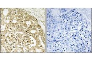 Immunohistochemistry analysis of paraffin-embedded human breast carcinoma tissue, using Catenin-beta (Ab-37) Antibody. (beta Catenin 抗体  (AA 3-52))