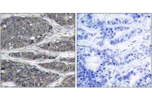 Immunohistochemistry analysis of paraffin-embedded human breast carcinoma tissue, using NF-kappaB p105/p50 (Ab-932) Antibody. (NFKB1 抗体  (AA 899-948))