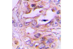 Immunohistochemical analysis of NDRG2 staining in human lung cancer formalin fixed paraffin embedded tissue section. (NDRG2 抗体  (Center))