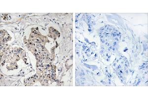 Peptide - +Immunohistochemistry analysis of paraffin-embedded human breast carcinoma tissue using BLK antibody. (BLK 抗体  (Internal Region))