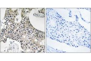 Immunohistochemistry analysis of paraffin-embedded human breast carcinoma tissue, using GPSN2 Antibody. (TECR 抗体  (AA 259-308))