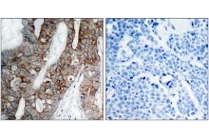 Immunohistochemistry analysis of paraffin-embedded human breast carcinoma tissue, using Integrin beta3 (Ab-773) Antibody. (Integrin beta 3 抗体  (AA 731-780))