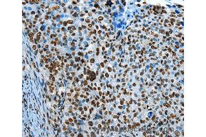 Immunohistochemistry of Human cervical cancer using CREB1 Polyclonal Antibody at dilution of 1:30 (CREB1 抗体)