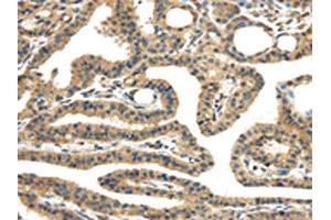 The image on the left is immunohistochemistry of paraffin-embedded Human thyroid cancer tissue using ABIN7131400(TMPRSS11E Antibody) at dilution 1/30, on the right is treated with fusion protein. (TMPRSS11E 抗体)