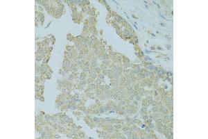 Immunohistochemistry of paraffin-embedded human colon carcinoma using MTFP1 antibody (ABIN5975088) at dilution of 1/100 (40x lens). (Mtfp1 抗体)