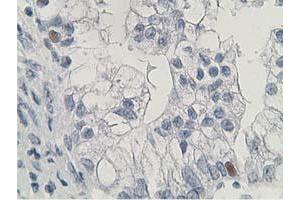 Immunohistochemical staining of paraffin-embedded Adenocarcinoma of Human ovary tissue using anti-HDHD2 mouse monoclonal antibody. (HDHD2 抗体)