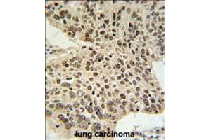 HIST1H2AL Antibody IHC analysis in formalin fixed and paraffin embedded human lung carcinoma followed by peroxidase conjugation of the secondary antibody and DAB staining. (HIST1H2AL 抗体  (C-Term))