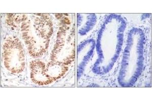 Immunohistochemistry analysis of paraffin-embedded human colon carcinoma, using p38 MAPK (Phospho-Tyr182) Antibody. (MAPK14 抗体  (pTyr182))