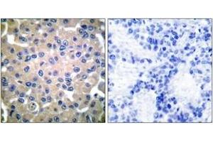 Immunohistochemistry analysis of paraffin-embedded human breast carcinoma tissue, using Transglutaminase 2 Antibody. (Transglutaminase 2 抗体  (AA 1-50))