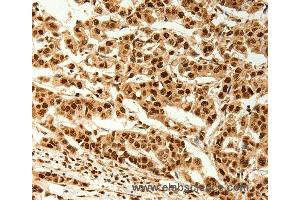Immunohistochemistry of Human breast cancer using C12orf5 Polyclonal Antibody at dilution of 1:80 (TIGAR 抗体)