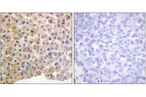 Immunohistochemistry analysis of paraffin-embedded human breast carcinoma, using IR (Phospho-Tyr1361) Antibody. (IR (AA 1331-1380), (pTyr1361) 抗体)