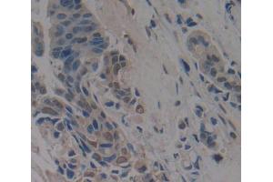 IHC-P analysis of breast cancer tissue, with DAB staining. (Anoctamin 2 抗体  (AA 823-1003))