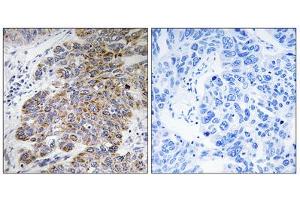 Immunohistochemistry analysis of paraffin-embedded human lung carcinoma tissue, using CHST10 antibody. (CHST10 抗体  (Internal Region))