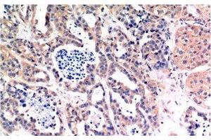 Immunohistochemistry of paraffin-embedded Human breast carcinoma tissue using Bax Monoclonal Antibody at dilution of 1:200. (BAX 抗体)