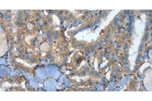 Immunohistochemistry of paraffin-embedded Human thyroid cancer tissue using ATP4B Polyclonal Antibody at dilution 1:40 (ATP4b 抗体)