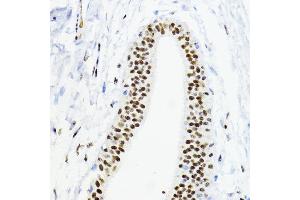 Immunohistochemistry of paraffin-embedded human mammary cancer using ZEB1 antibody (ABIN6129933, ABIN6150422, ABIN6150423 and ABIN6221237) at dilution of 1:200 (40x lens). (ZEB1 抗体  (AA 1-260))