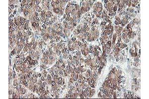 Immunohistochemical staining of paraffin-embedded Carcinoma of Human liver tissue using anti-RPN1 mouse monoclonal antibody. (RPN1 抗体)