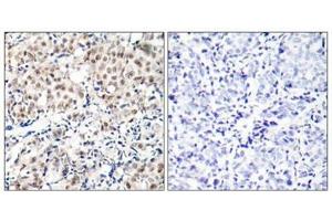 Immunohistochemical analysis of paraffin-embedded human breast carcinoma tissue using p27Kip1(Phospho-Thr187) Antibody(left) or the same antibody preincubated with blocking peptide(right). (CDKN1B 抗体  (pThr187))