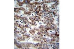 Immunohistochemistry analysis in formalin fixed and paraffin embedded human liver tissue reacted with GCD / GCDH Antibody (C-term) followed by peroxidase conjugation of the secondary antibody and DAB staining. (GCDH 抗体  (C-Term))