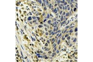 Immunohistochemical analysis of Cytochrome P450 1A1 staining in human esophageal cancer formalin fixed paraffin embedded tissue section. (CYP1A1 抗体)