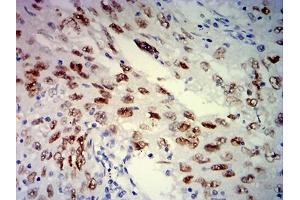 Immunohistochemical analysis of paraffin-embedded lung cancer tissues using MSH6 mouse mAb with DAB staining. (MSH6 抗体  (AA 374-540))