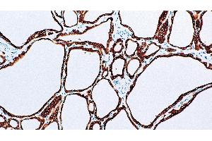 Thyroid, Graves' disease: immunohistochemical staining for Thyroid Peroxidase. (Thyroperoxidase 抗体  (N-Term))