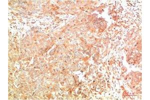 Immunohistochemical analysis of paraffin-embedded Human Breast Carcinoma Tissue using ATG7 Mouse mAb diluted at 1:200. (ATG7 抗体)