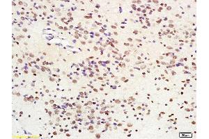 Formalin-fixed and paraffin embedded human glioma tissue labeled with Anti-SIRT1 Polyclonal Antibody, Unconjugated (ABIN679028) at 1:200 followed by conjugation to the secondary antibody and DAB staining (SIRT1 抗体  (AA 551-650))