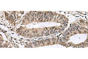 Immunohistochemistry of paraffin-embedded Human colorectal cancer tissue using TMX3 Polyclonal Antibody at dilution of 1:70(x200) (TMX3 抗体)