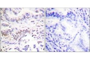 Immunohistochemistry analysis of paraffin-embedded human lung carcinoma tissue, using XRCC3 Antibody. (RCC3 (AA 41-90) 抗体)