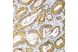 Immunohistochemical analysis of AGXT2L2 staining in human colon cancer formalin fixed paraffin embedded tissue section. (AGXT2L2 抗体  (C-Term))