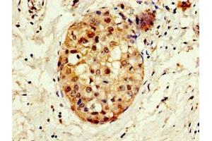 Immunohistochemistry of paraffin-embedded human breast cancer using ABIN7148671 at dilution of 1:100 (CBP 抗体  (AA 2217-2442))