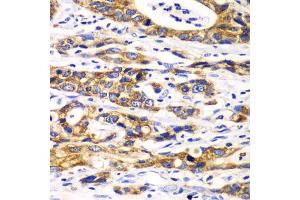 Immunohistochemistry of paraffin-embedded human gastric cancer using RPN1 antibody. (RPN1 抗体)