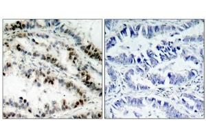 Immunohistochemical analysis of paraffin-embedded human lung carcinoma tissue using SMC1(Phospho-Ser957) Antibody(left) or the same antibody preincubated with blocking peptide(right). (SMC1A 抗体  (pSer957))