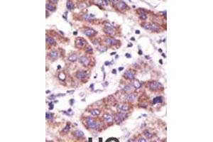 Formalin-fixed and paraffin-embedded human cancer tissue reacted with the primary antibody, which was peroxidase-conjugated to the secondary antibody, followed by DAB staining. (USP3 抗体  (N-Term))