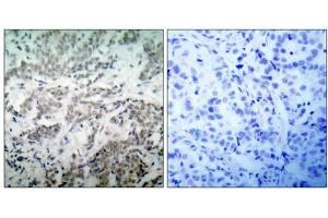 Immunohistochemical analysis of paraffin- embedded human breast carcinoma tissue using BCL-2(Ab-56) antibody (E021059). (Bcl-2 抗体)