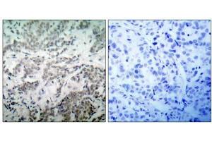 Immunohistochemical analysis of paraffin-embedded human breast carcinoma tissue using p53 (Ab-15) antibody (E021085). (p53 抗体)