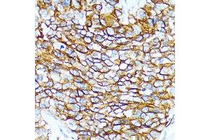 Immunohistochemistry of paraffin-embedded human oophoroma using CD239/BCAM Rabbit mAb (ABIN7265828) at dilution of 1:100 (40x lens). (BCAM 抗体)