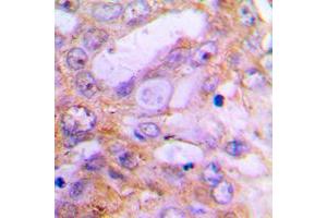 Immunohistochemical analysis of Caspase 12 staining in human lung cancer formalin fixed paraffin embedded tissue section. (Caspase 12 抗体  (Center))