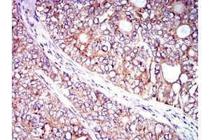 Immunohistochemical analysis of paraffin-embedded cervical cancer tissues using CD102 mouse mAb with DAB staining. (ICAM2 抗体  (AA 25-223))