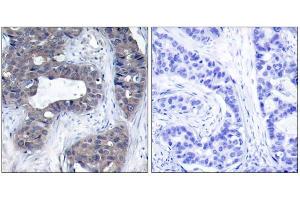 Immunohistochemical analysis of paraffin-embedded human breast carcinoma tissue, using IRS-1 (Ab-307) antibody (E021228). (IRS1 抗体)