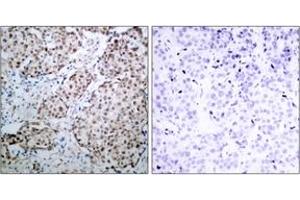 Immunohistochemistry analysis of paraffin-embedded human breast carcinoma, using p53 (Phospho-Ser315) Antibody. (p53 抗体  (pSer315))