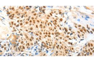 Immunohistochemistry of paraffin-embedded Human esophagus cancer using APPL1 Polyclonal Antibody at dilution of 1:70 (APPL1 抗体)